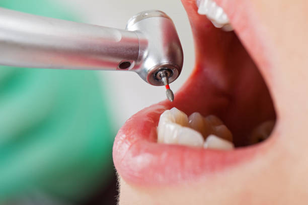 Best Lost Filling or Crown Replacement in Franklin, KY